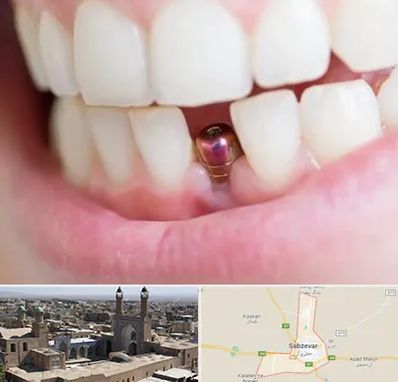 ایمپلنت اقساطی در سبزوار