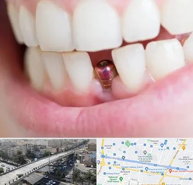 ایمپلنت اقساطی در فرجام 