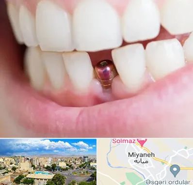 ایمپلنت اقساطی در میانه