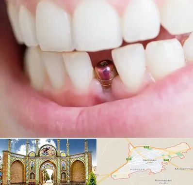 ایمپلنت اقساطی در سمنان