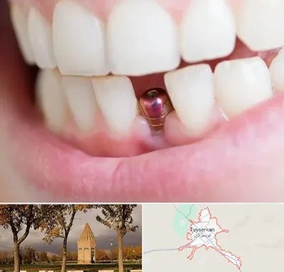 ایمپلنت اقساطی در تویسرکان