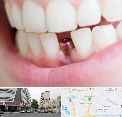 ایمپلنت اقساطی در بلوار فردوس 