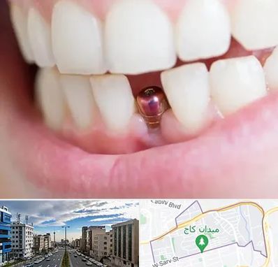 ایمپلنت اقساطی در سعادت آباد 