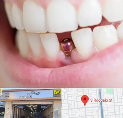 ایمپلنت اقساطی در رودکی