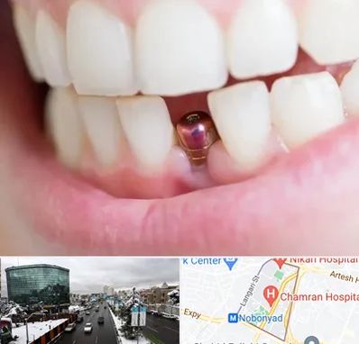 ایمپلنت اقساطی در اقدسیه 