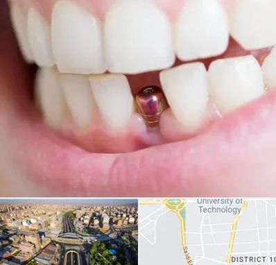 ایمپلنت اقساطی در استاد معین 