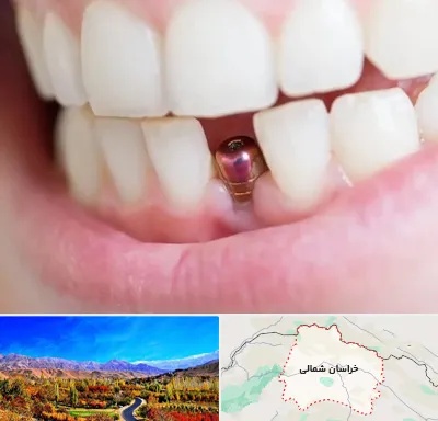 ایمپلنت اقساطی در خراسان شمالی