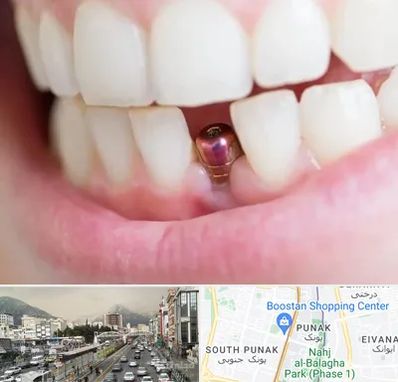 ایمپلنت اقساطی در پونک 