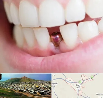 ایمپلنت اقساطی در بیجار