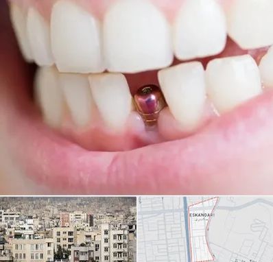 ایمپلنت اقساطی در اسکندری