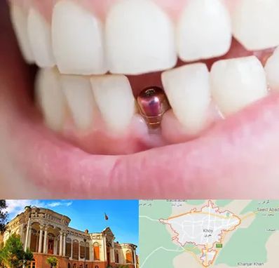 ایمپلنت اقساطی در خوی