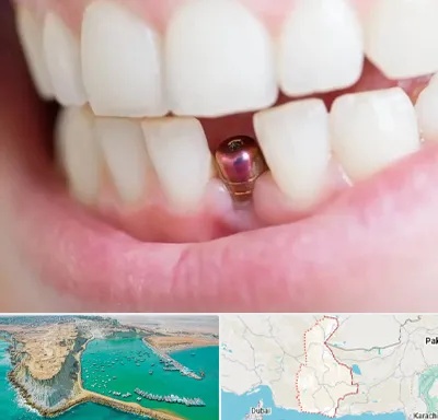 ایمپلنت اقساطی در سیستان و بلوچستان