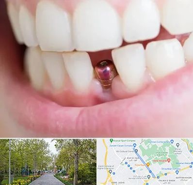 ایمپلنت اقساطی در قدوسی غربی شیراز