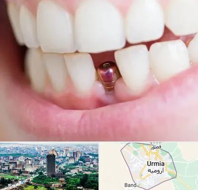 ایمپلنت اقساطی در ارومیه