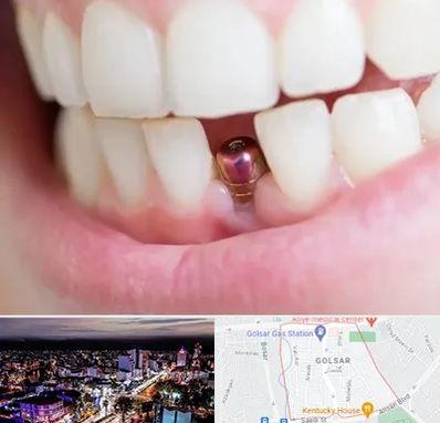 ایمپلنت اقساطی در گلسار رشت 