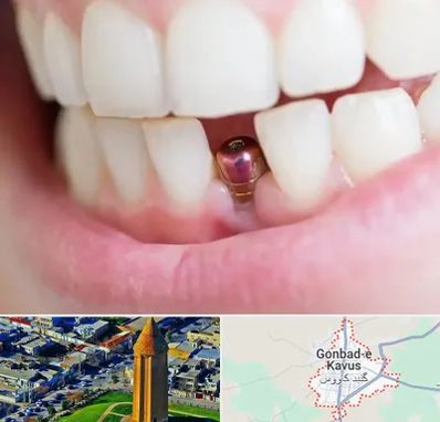 ایمپلنت اقساطی در گنبد کاووس