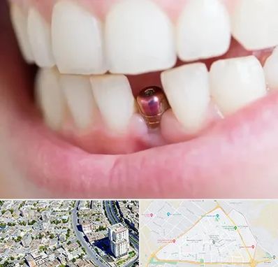 ایمپلنت اقساطی در قاسم آباد مشهد 