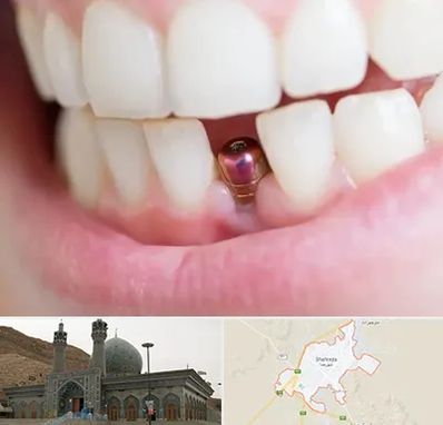 ایمپلنت اقساطی در شهرضا