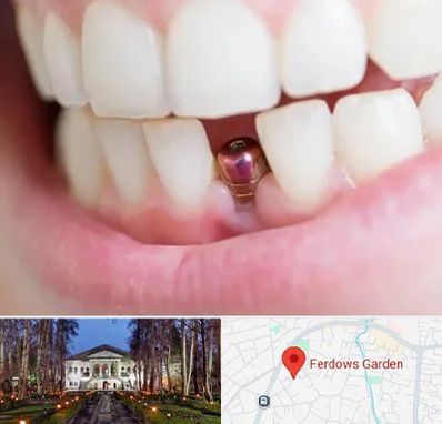 ایمپلنت اقساطی در باغ فردوس