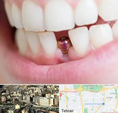 ایمپلنت اقساطی در مرزداران 