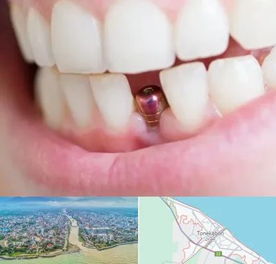 ایمپلنت اقساطی در تنکابن