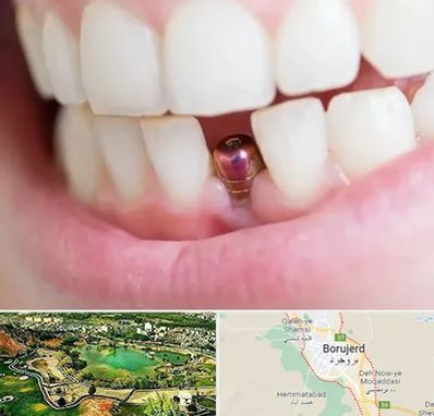 ایمپلنت اقساطی در بروجرد