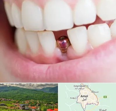 ایمپلنت اقساطی در آمل