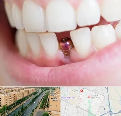 ایمپلنت اقساطی در فاز سه اندیشه
