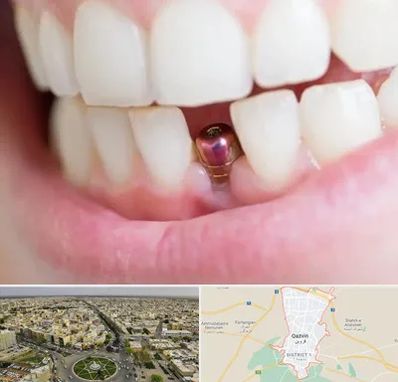 ایمپلنت اقساطی در قزوین