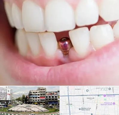 ایمپلنت اقساطی در مرکز تهران