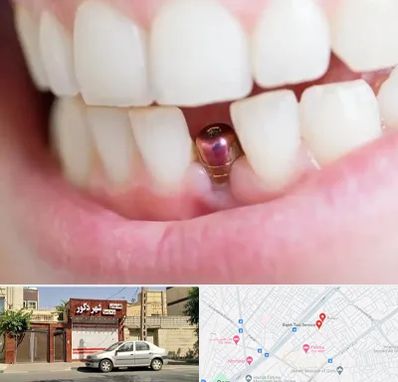 ایمپلنت اقساطی در باجک قم