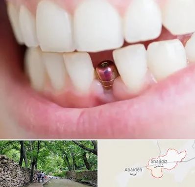 ایمپلنت اقساطی در شاندیز مشهد