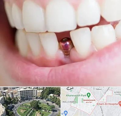 ایمپلنت اقساطی در جهانشهر کرج 