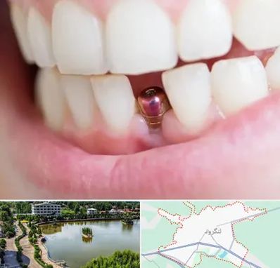 ایمپلنت اقساطی در لنگرود