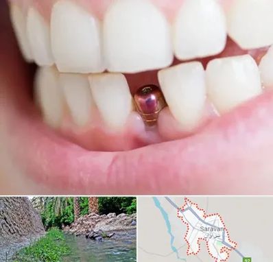 ایمپلنت اقساطی در سراوان