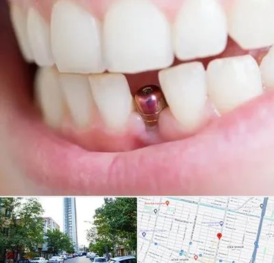 ایمپلنت اقساطی در امامت مشهد