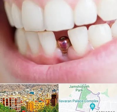 ایمپلنت اقساطی در نیاوران 