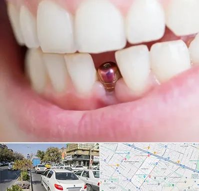 ایمپلنت اقساطی در مفتح مشهد