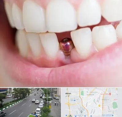 ایمپلنت اقساطی در ستارخان 