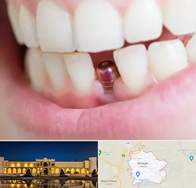 ایمپلنت اقساطی در برازجان