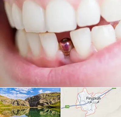 ایمپلنت اقساطی در فیروزکوه
