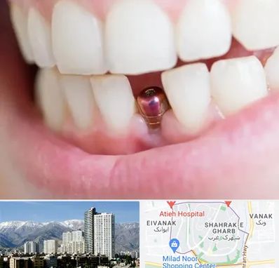 ایمپلنت اقساطی در شهرک غرب 