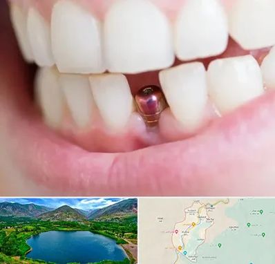 ایمپلنت اقساطی در رودبار