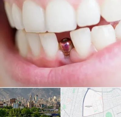 ایمپلنت اقساطی در جمشیدیه