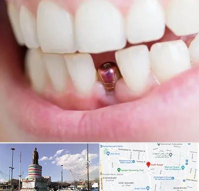 ایمپلنت اقساطی در کارگر جنوبی 