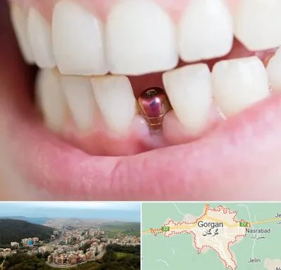 ایمپلنت اقساطی در گرگان