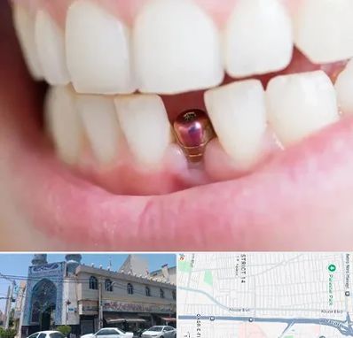 ایمپلنت اقساطی در بلوار ابوذر