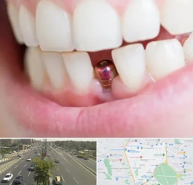 ایمپلنت اقساطی در منطقه 17 تهران 