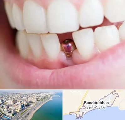 ایمپلنت اقساطی در بندرعباس