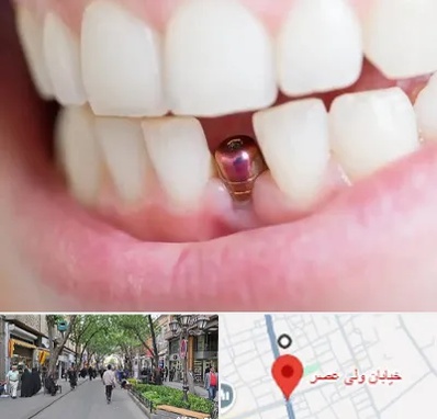 ایمپلنت اقساطی در ولیعصر شهریار